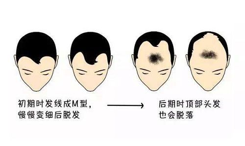 头发稀少_头发稀少八个方法让头发变浓_额头头发稀少怎么办