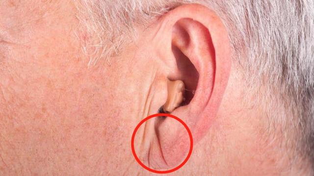 耳朵皱纹预示疾病图片图片