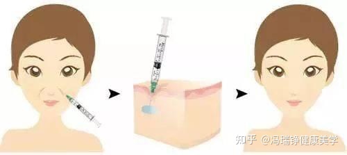 瑞兰祛法令纹_孕妇自制面膜祛法令纹_祛法令纹