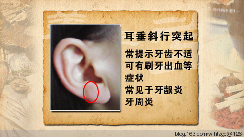 耳朵后面长了个硬包图_耳朵长痣面相图_耳朵上长了个硬包图