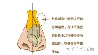 鼻子歪 面相_鼻子软骨不硬软软的鼻子会长歪吗_鼻子有点歪