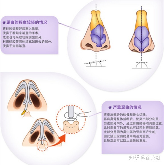 鼻子歪 面相_鼻子有点歪_深圳鼻子畸形歪整形多少钱