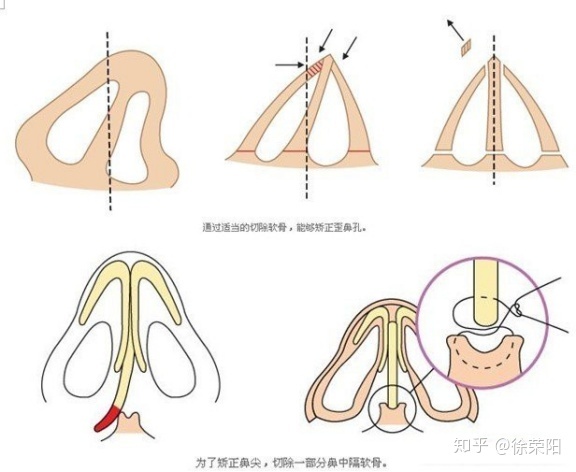 鼻子歪 面相_深圳鼻子畸形歪整形多少钱_鼻子有点歪