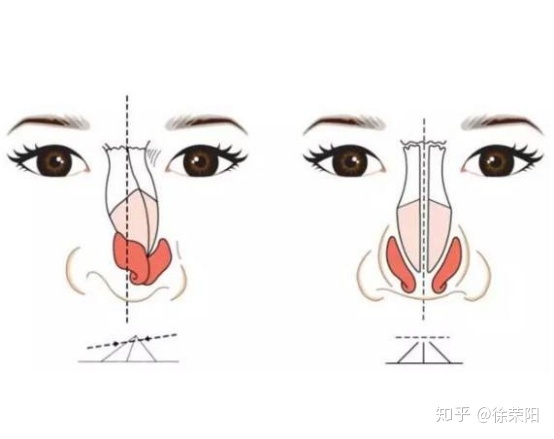 歪鼻子_鼻子有点歪_歪鼻子歪嘴的图片