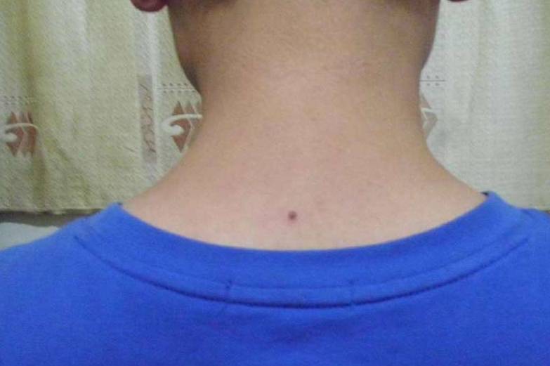 颈部下方长痣代表什么 脖子上有痣代表什么