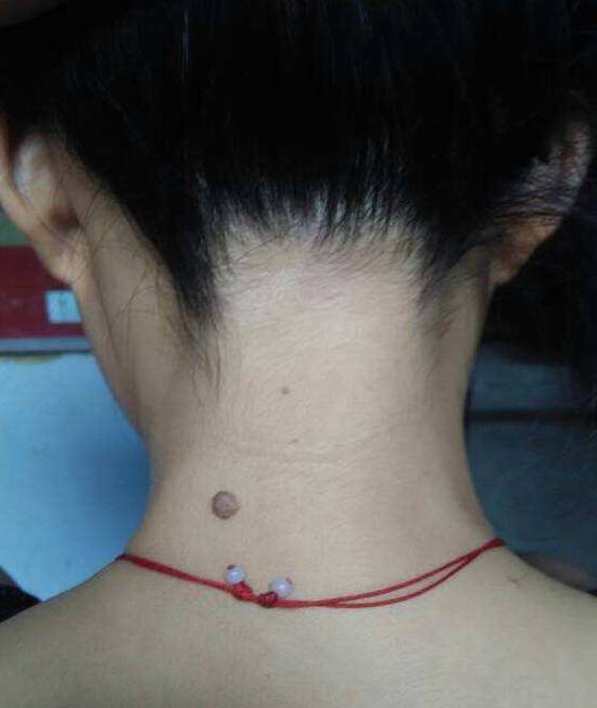 脖子后面有痣代表什么_女生脖子后面左侧有痣_女人脖子后面左边有痣