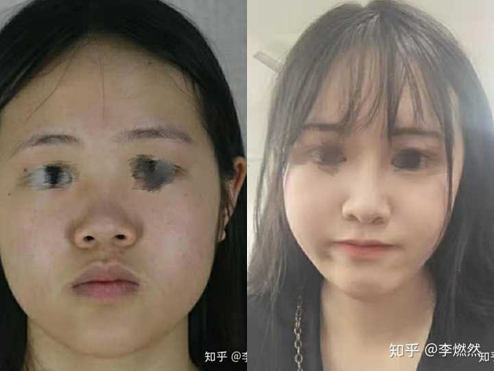 鼻子塌陷_整容鼻子塌陷图片_鼻子塌陷任娜英好了吗