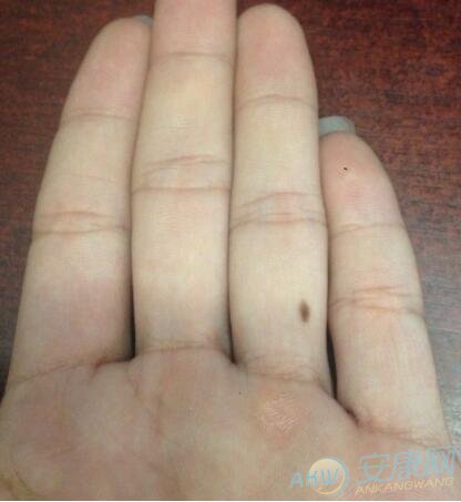【右手无名指上有痣代表什么】右手无名指有痣代表什么？从痣的位置来看