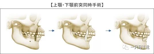 下巴短小_下巴短小后缩怎么办_下巴短小怎么化妆