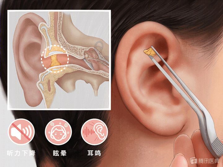 掏完耳朵咽东西耳朵疼_梦见把自己耳朵掏流血了_梦见掏耳朵