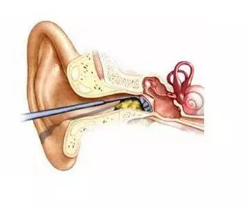 耳朵被棉签掏烂了_掏耳朵掏的耳朵疼_梦见掏耳朵