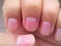 指甲上的月牙、竖纹、白点代表什么？这8种指甲问题，有可能隐藏大麻烦