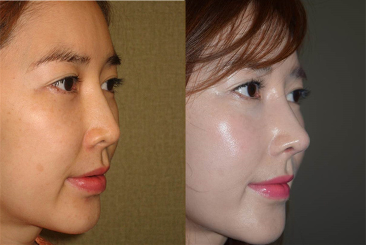 综合鼻整形+双眼皮手术恢复过程案例-4 - 好大夫在线