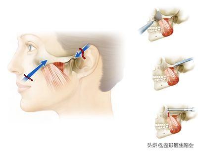 颧骨_颧骨宽与颧骨高图片_颧骨高与颧骨宽一样吗