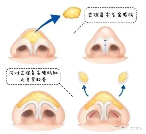 鼻尖大_耳软骨垫鼻尖鼻尖发白_鼻尖美容术