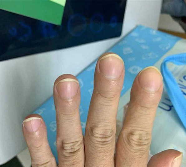 指甲发黑“痔”会出现在皮肤表面僵硬，怎么办？