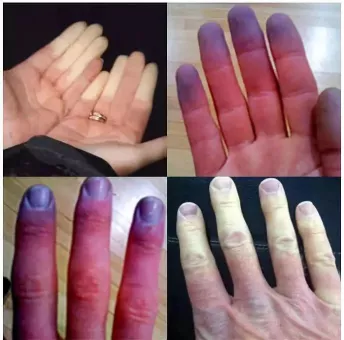 指甲发黑“痔”会出现在皮肤表面僵硬，怎么办？