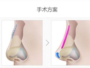 如何改善驼峰鼻