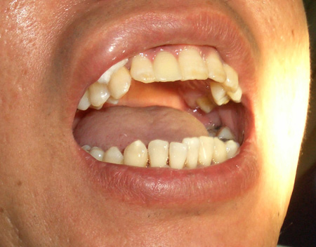 女人牙齿面相：牙齿看女人一生命运