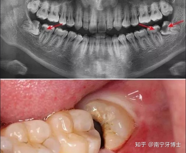 补整颗牙齿大概多少钱左右？牙齿坏掉了不拔有什么危害？