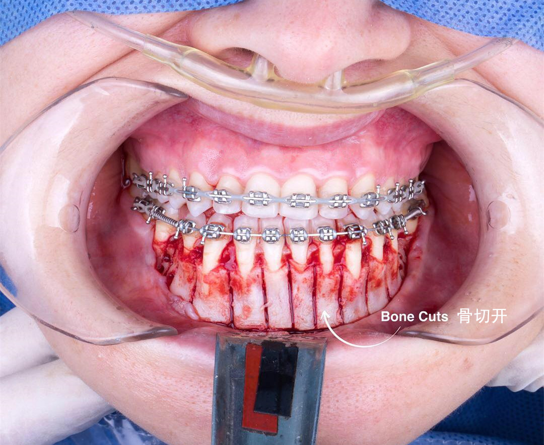 盘锦牙齿稀疏缝大正畸哪家-有口碑的盘锦牙齿正畸服务推荐