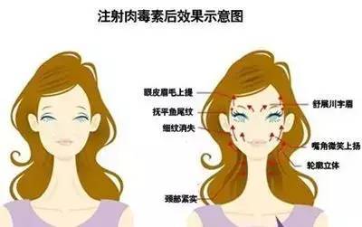 如何去除抬头纹？