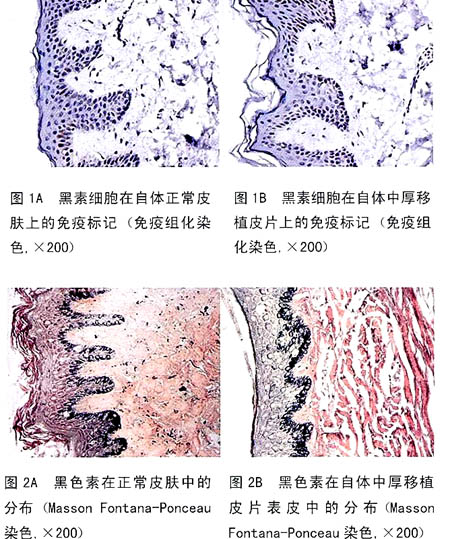 手上长痣 揭秘右手的手背上长痣的含义