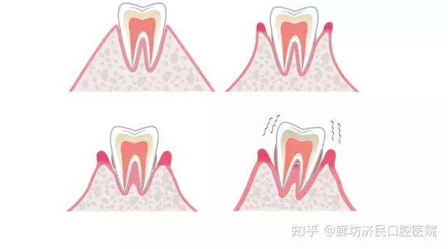 牙齿变长牙缝变宽...注意！你的牙龈正在萎缩！