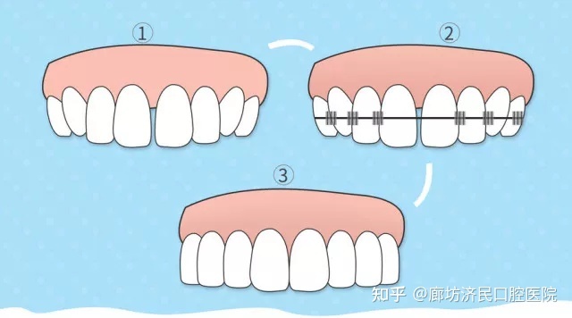 牙齿变长牙缝变宽...注意！你的牙龈正在萎缩！