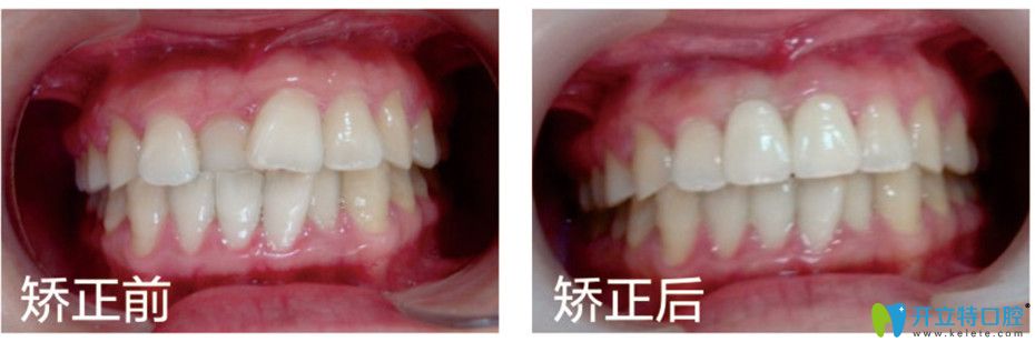 牙齿在面相里代表什么 门牙代表婚姻