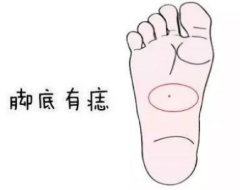 男人右脚底有痣代表什么， 男人右脚底有痣好不好